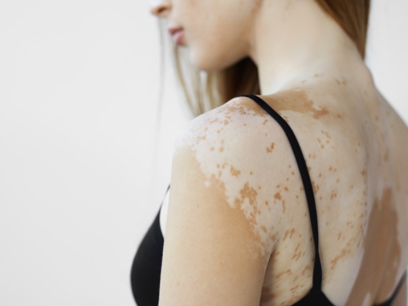 Schlankes weibliches Modell in schwarzem Tank-Top, das an Vitiligo leidet.